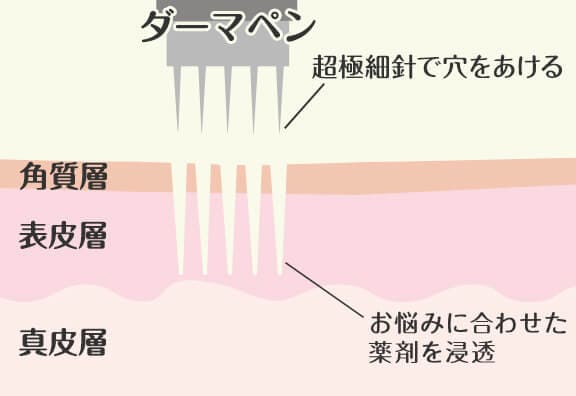 そもそもダーマペンとは？