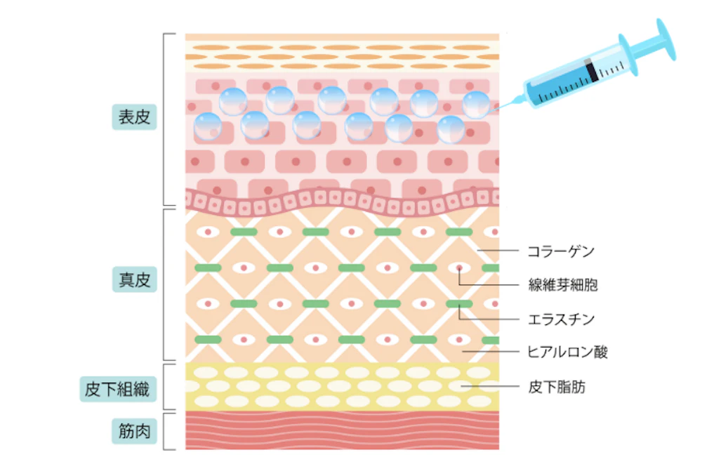 マイクロボトックスとは?