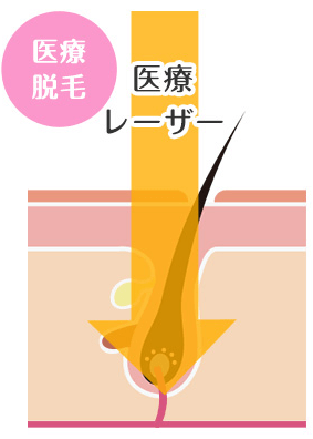 医療脱毛の脱毛機器