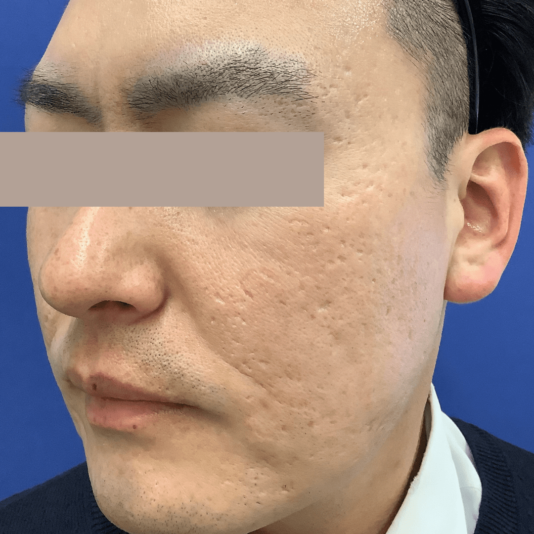 施術後