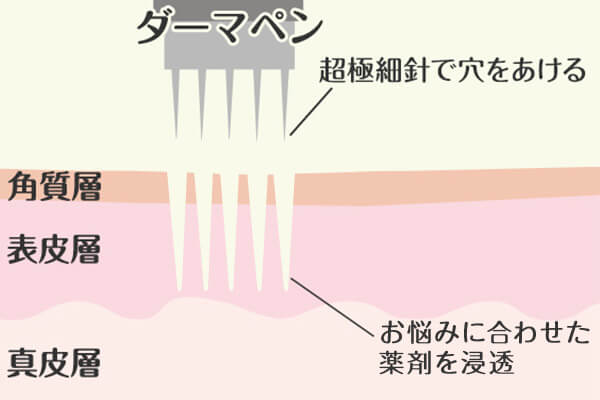 そもそもダーマペンって何？簡単に解説！