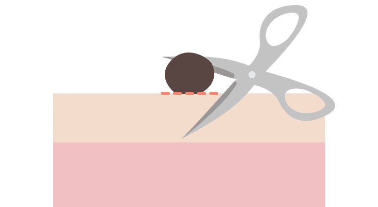 イボ・ほくろ 切除法の解説イラスト